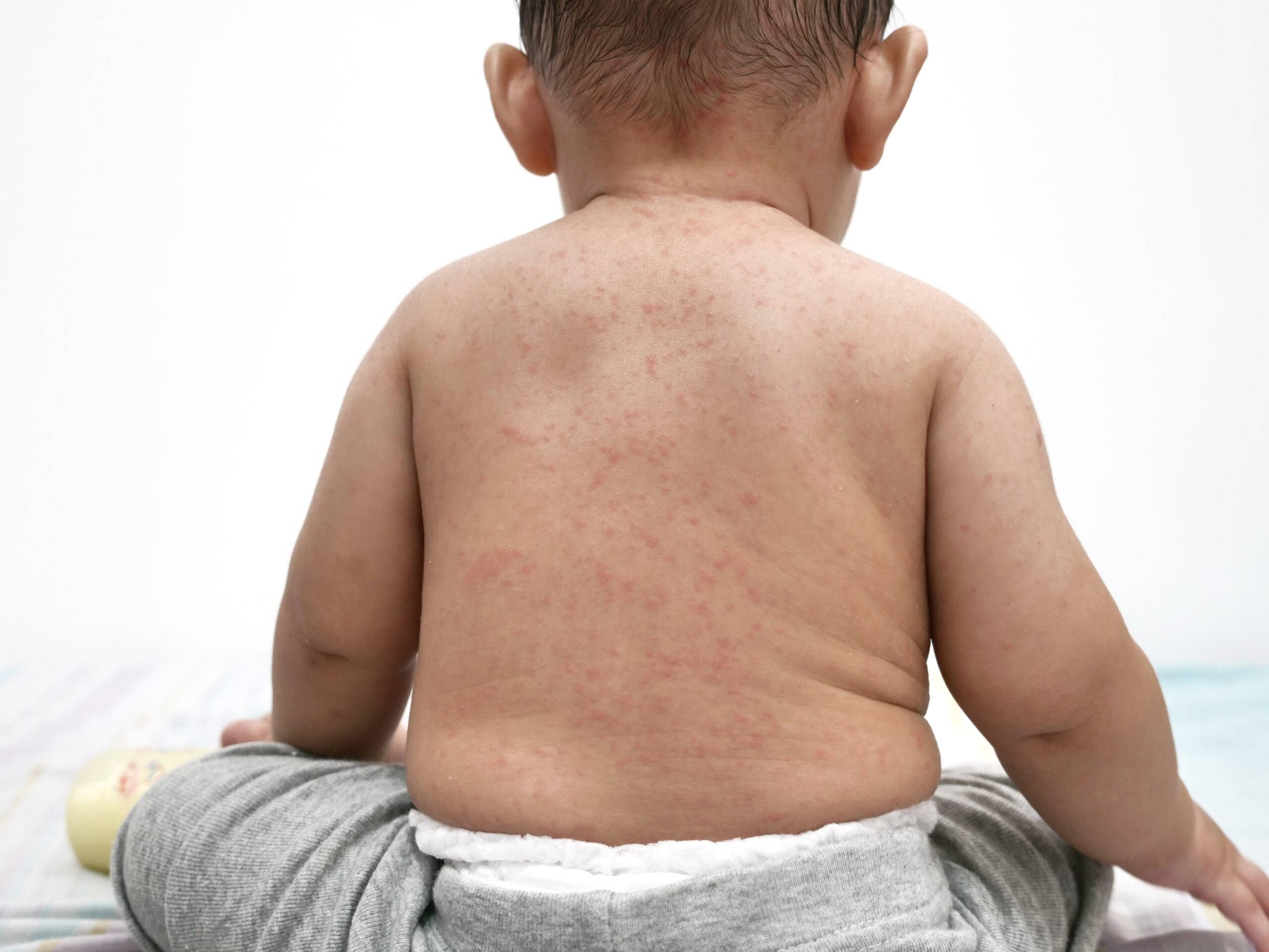 EMERGENCY HEALTH ALERT: MEASLES SPREADS RAPIDLY—TRIBAL COMMUNITIES AT RISK