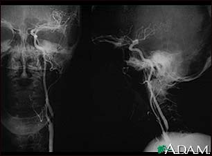 Carotid stenosis - X-ray of the left artery